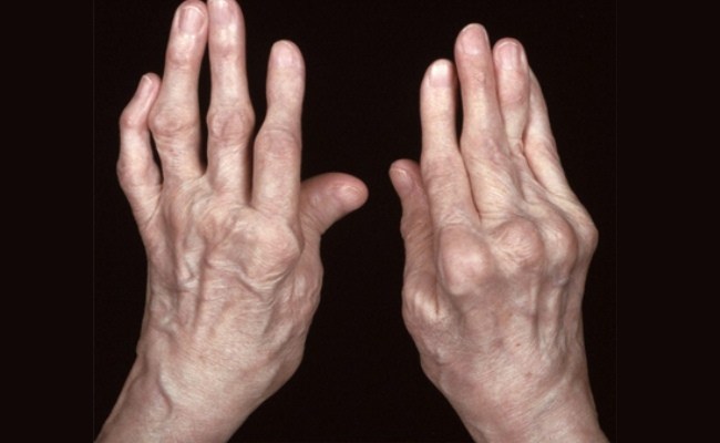 Hand Arthritis: Symptom, Treatment And Exercise | New Health Advisor